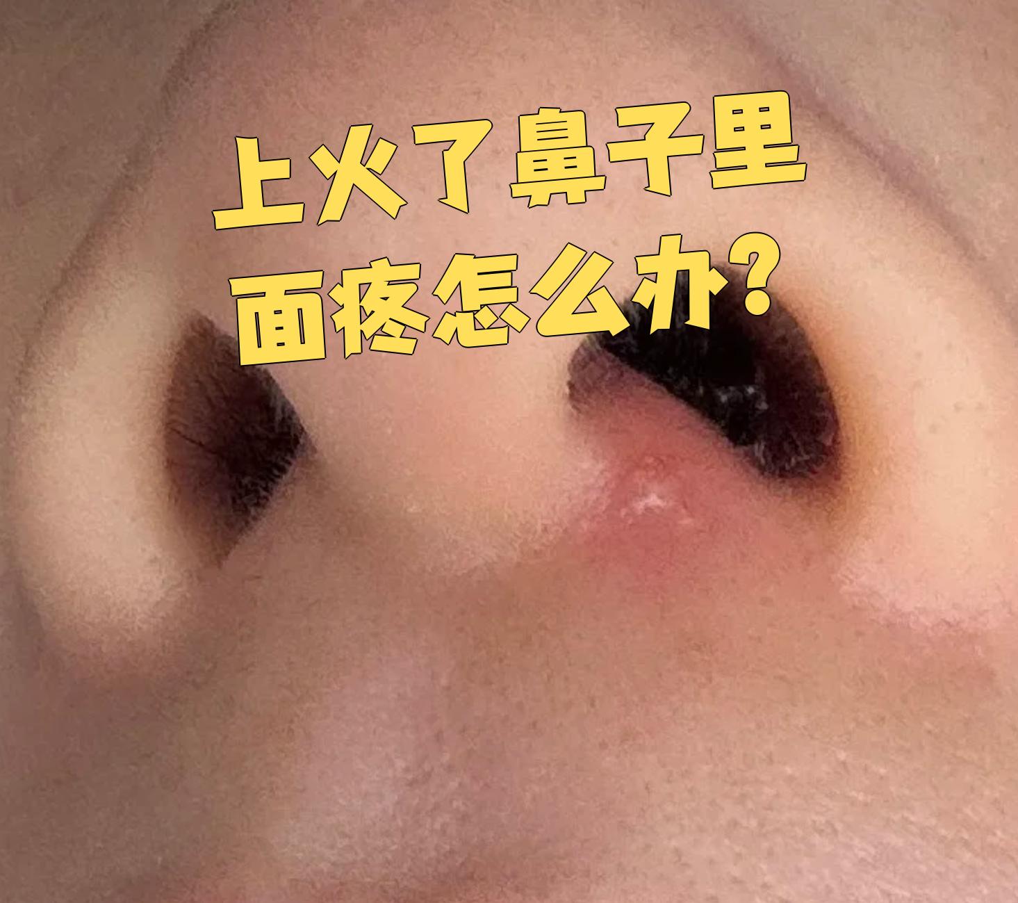 一不小心捏了一下鼻子就红了.他们说这是火气
