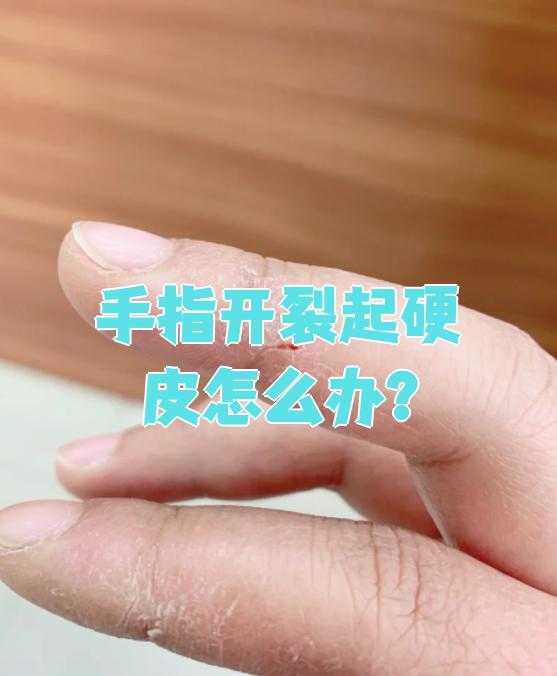 手裂怎么治疗
