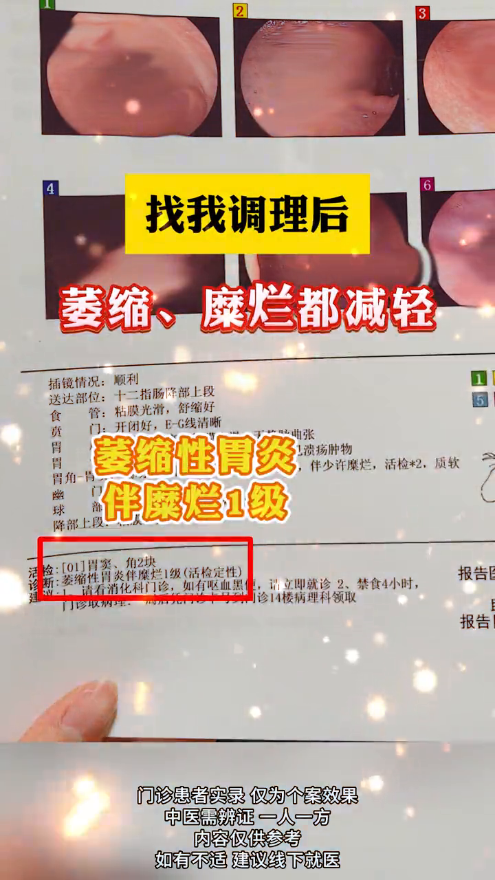 萎缩性胃炎严重吗?