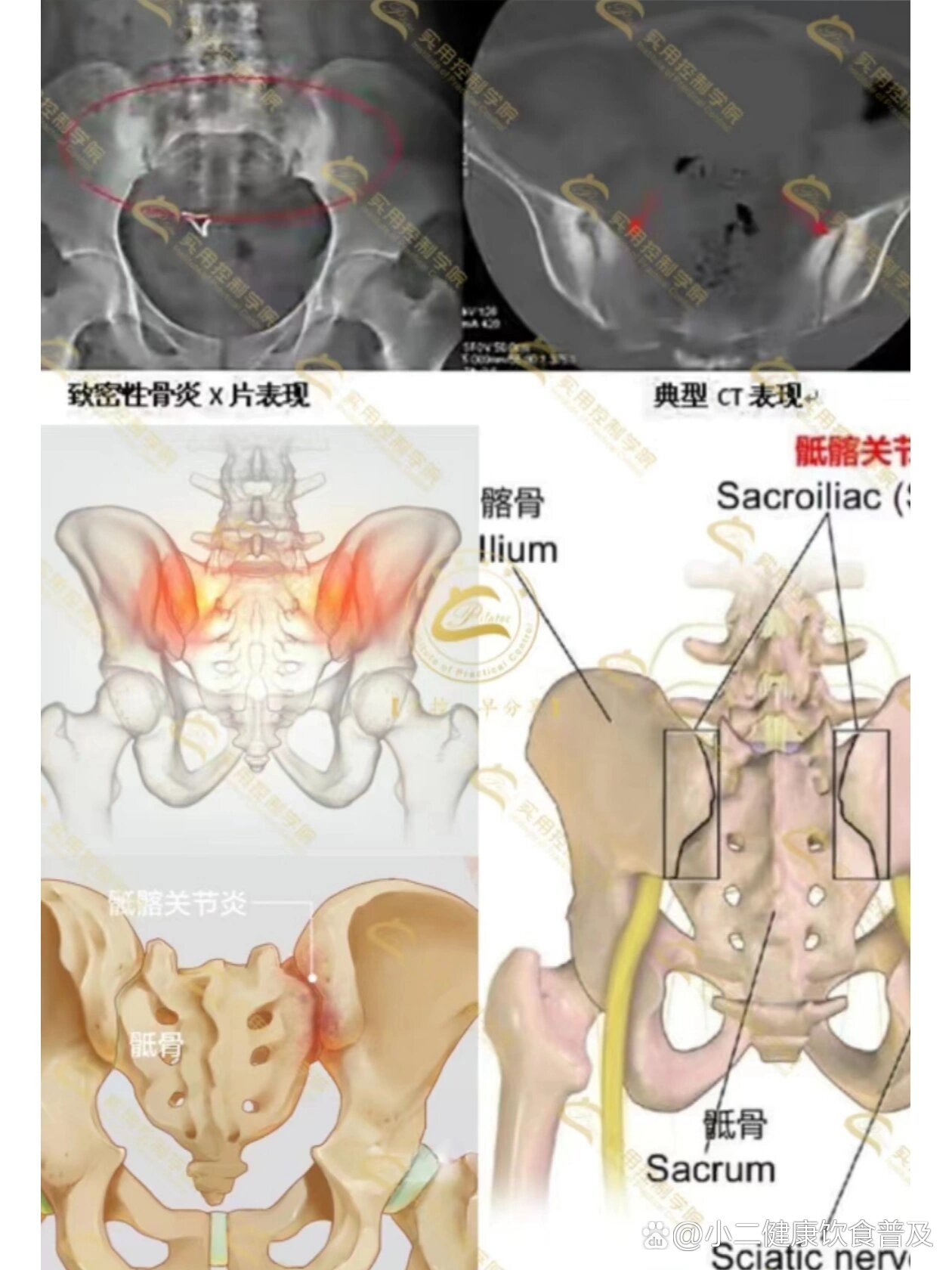 骶髂关节