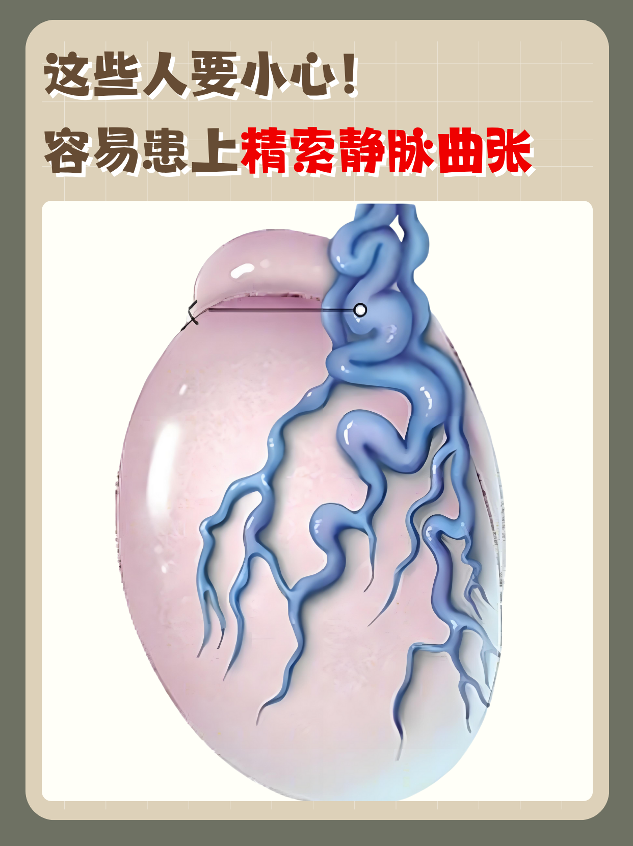 精索静脉曲张症的症状表现