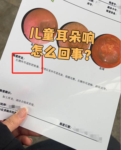 什么是急性化脓性中耳炎
