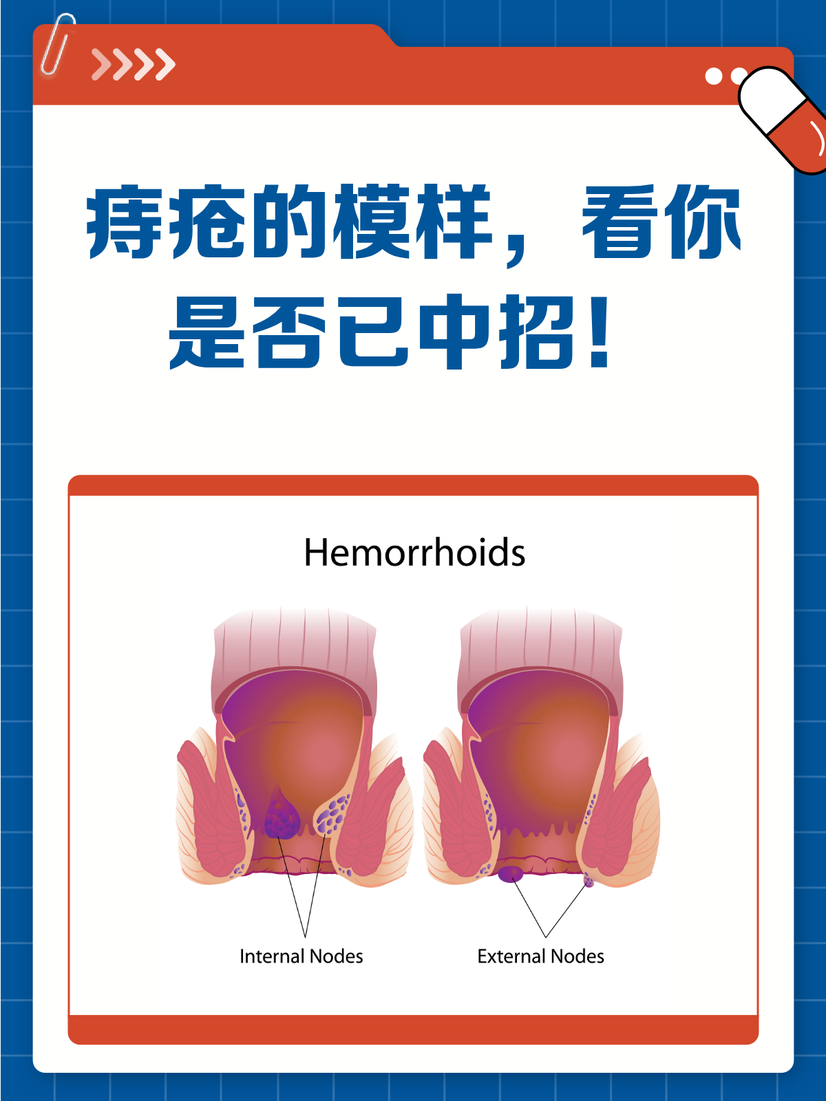 痔疮的症状表现有哪些?