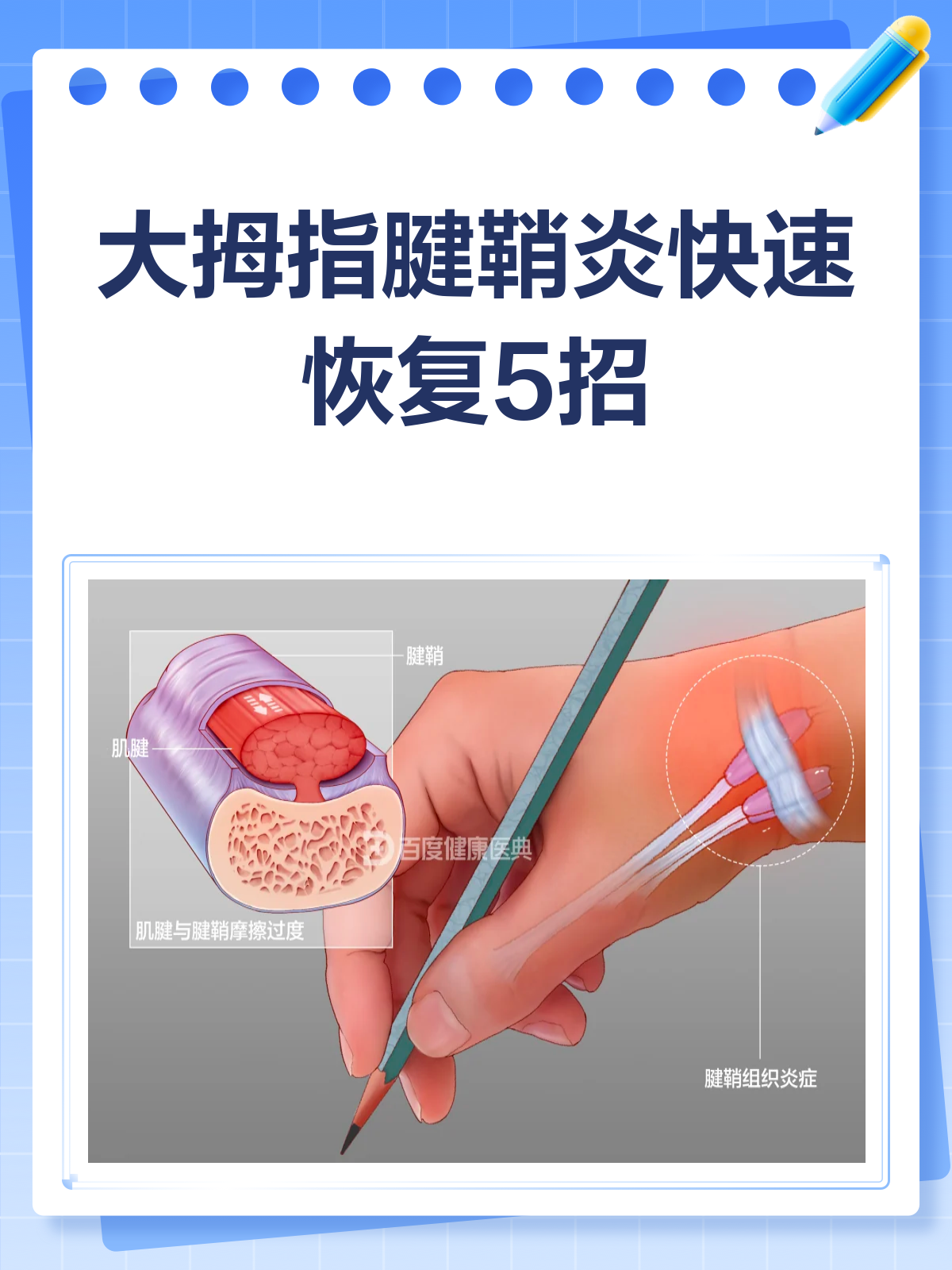 大拇指腱鞘炎有偏方吗?