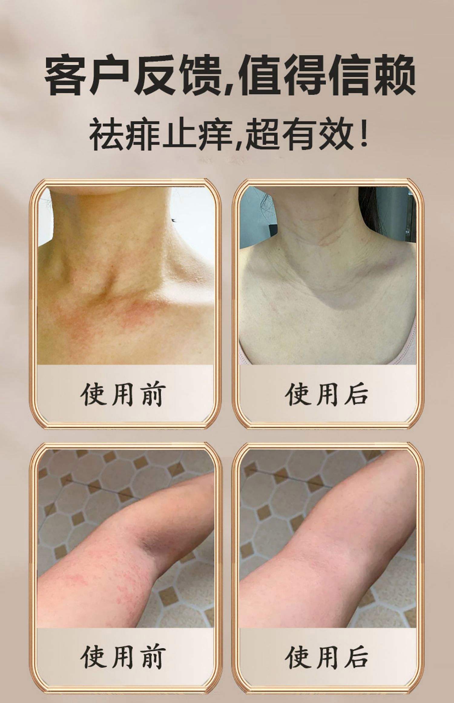 热痱子怎么治疗
