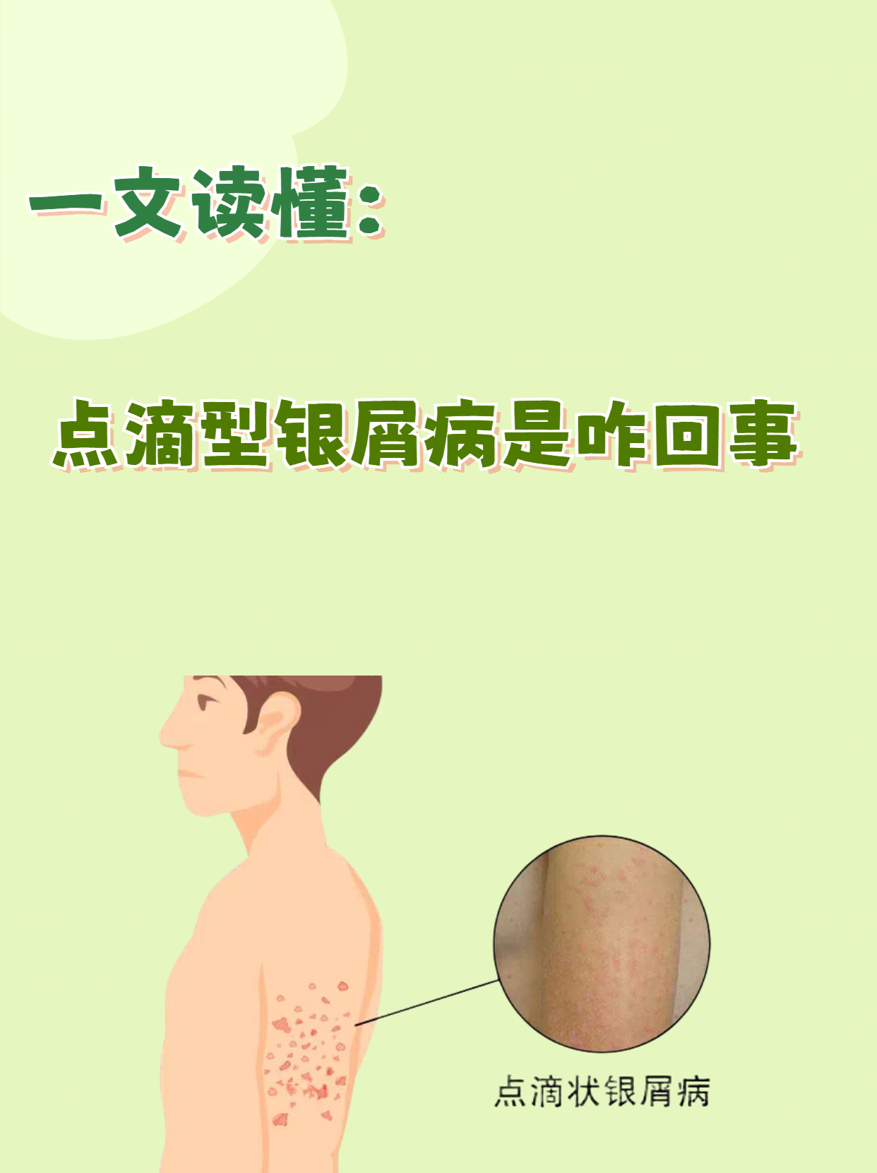 银屑病传染吗可怕吗