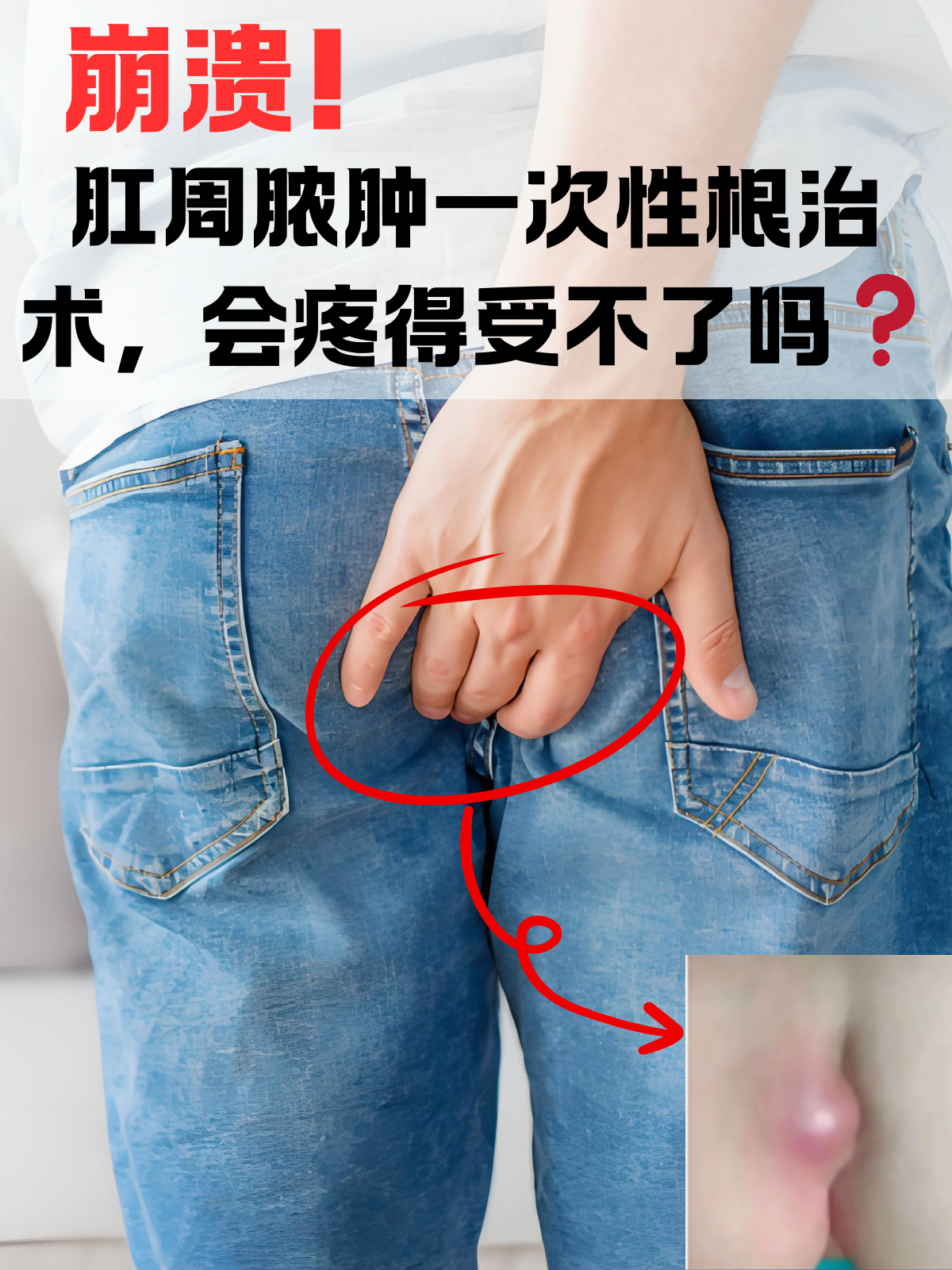 肛周脓肿最佳治疗方法