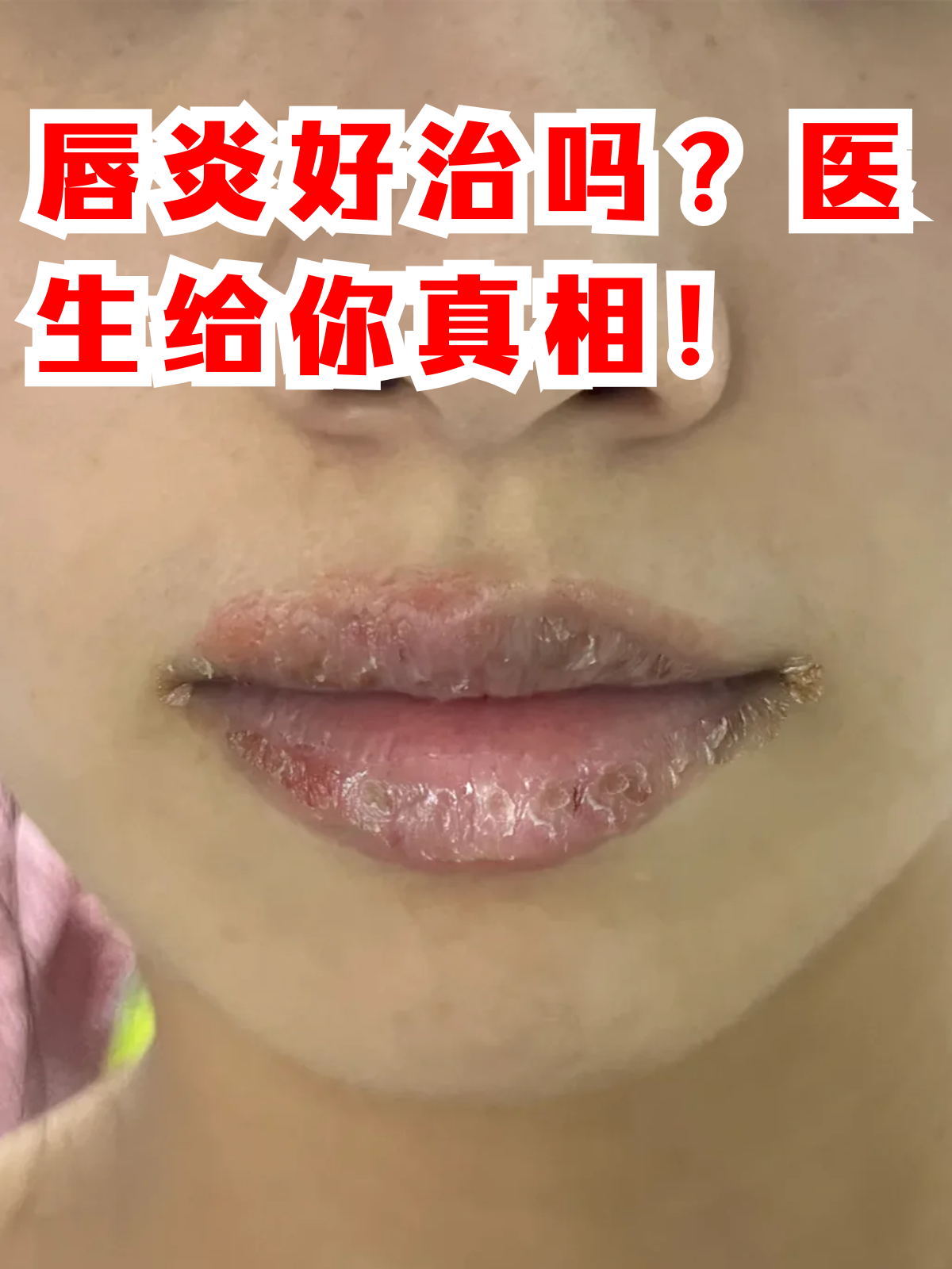嘴唇边缘痒怎么止痒