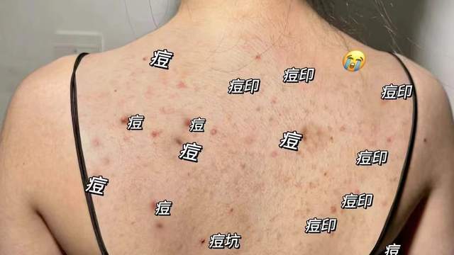 外阴长了一颗痘什么情况