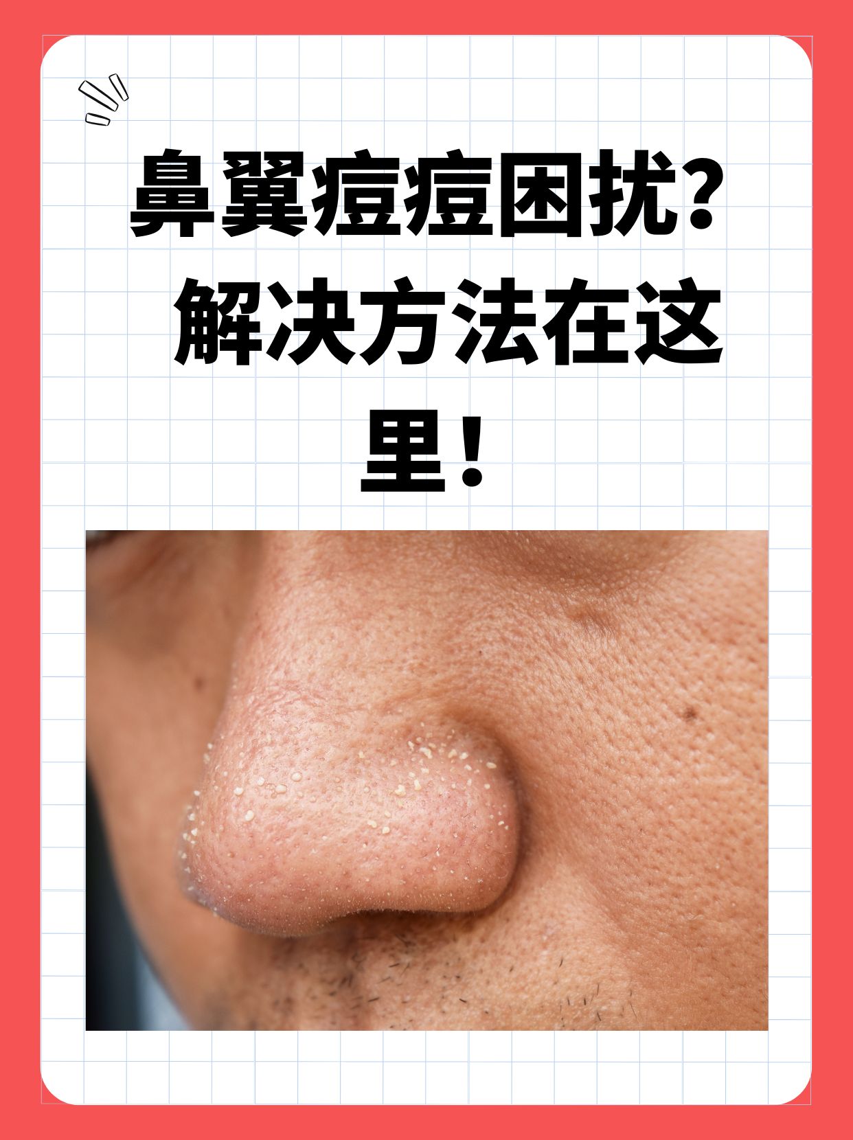 鼻子头长痘怎么回事