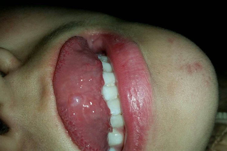 唾液腺囊肿能自愈吗