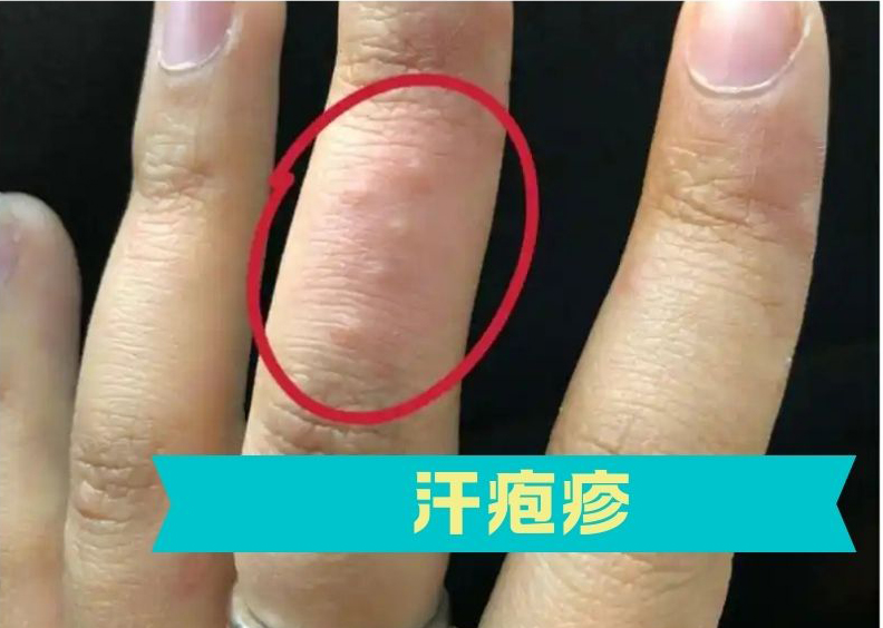 一到夏天手上就会起水泡