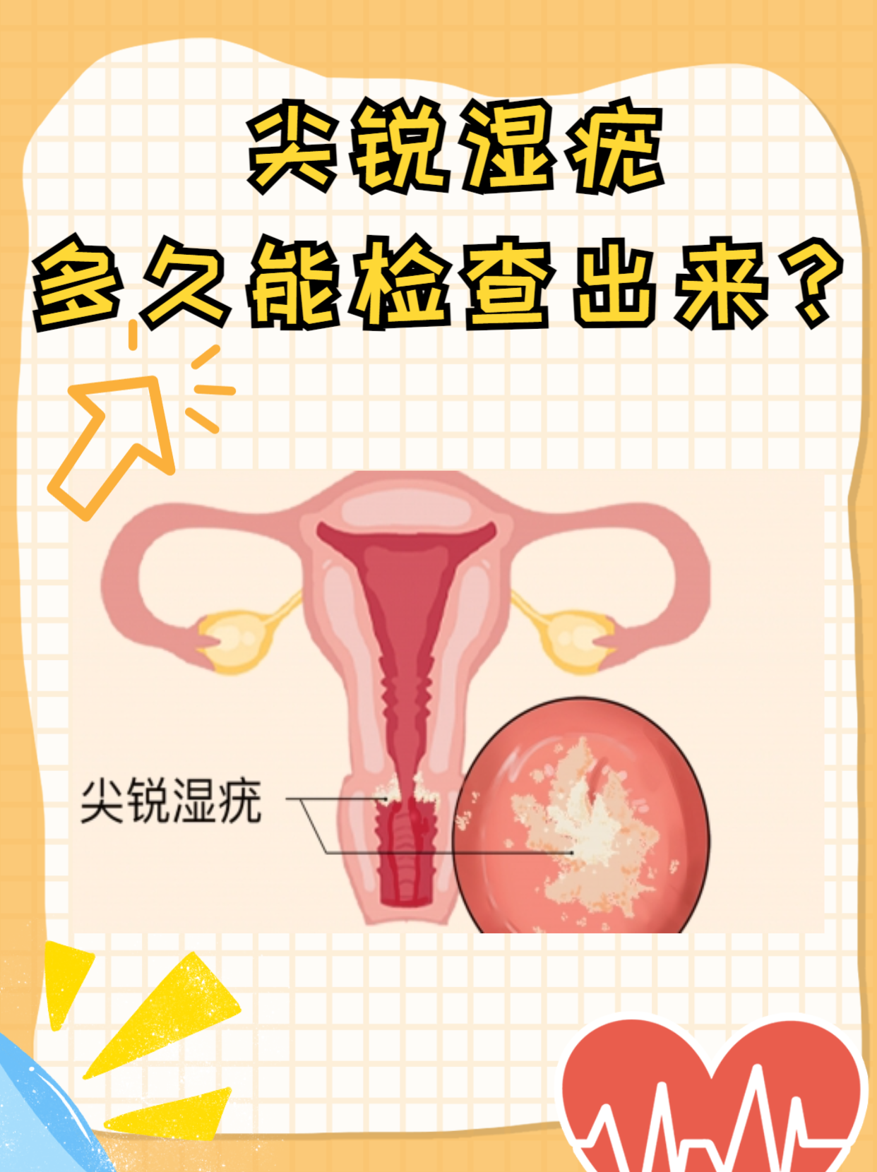 尖锐湿疣可以自愈吗