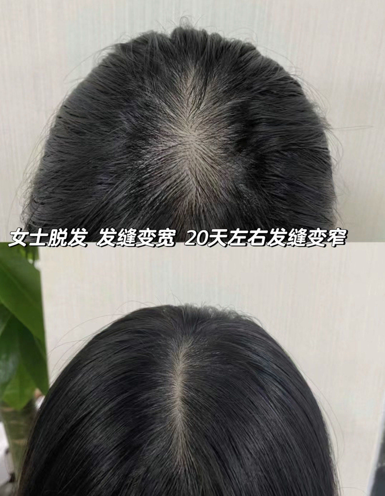 女性脱发怎么治疗