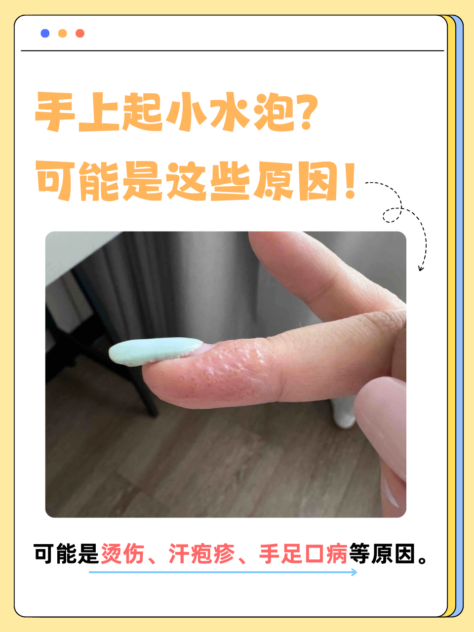 手容易出汗该怎么办