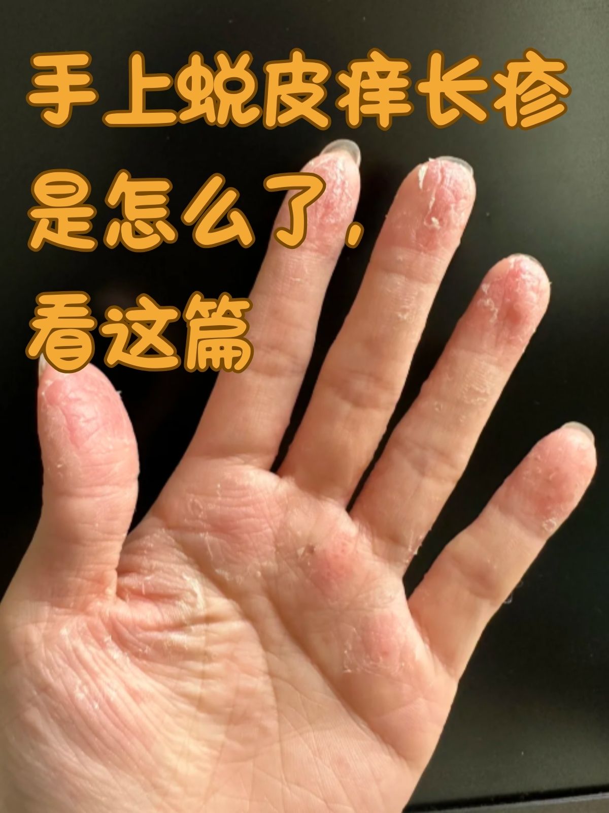 手一直红是什么原因造成