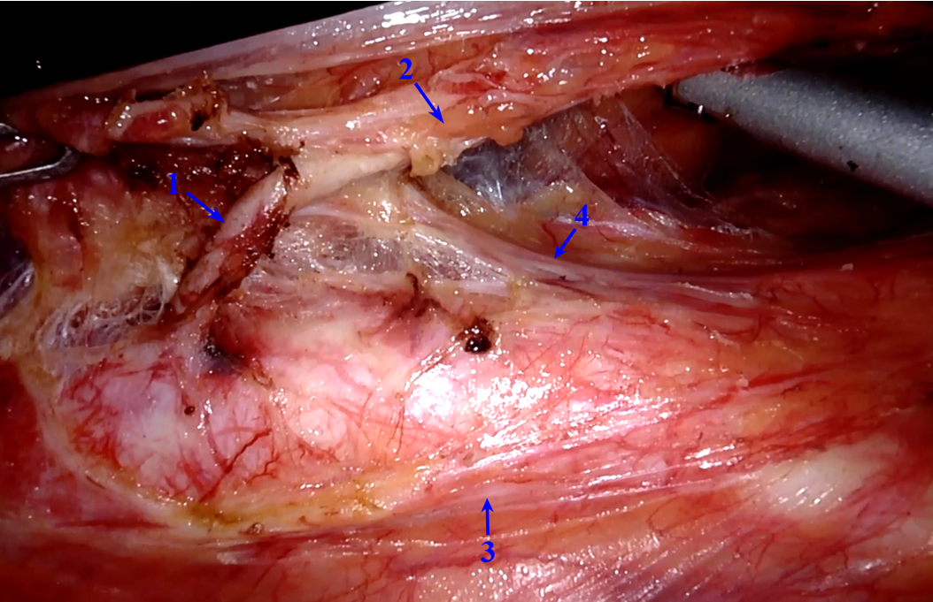 直肠癌的手术有几种