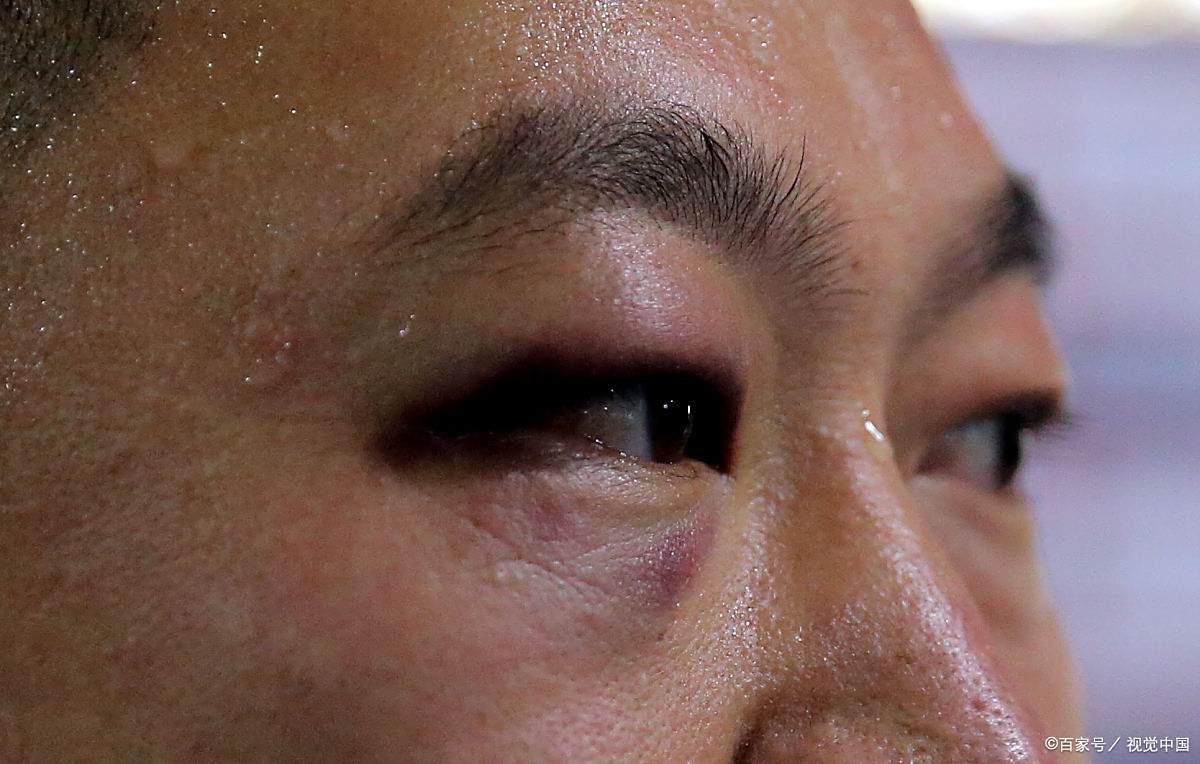 一只眼皮肿是肾病吗?