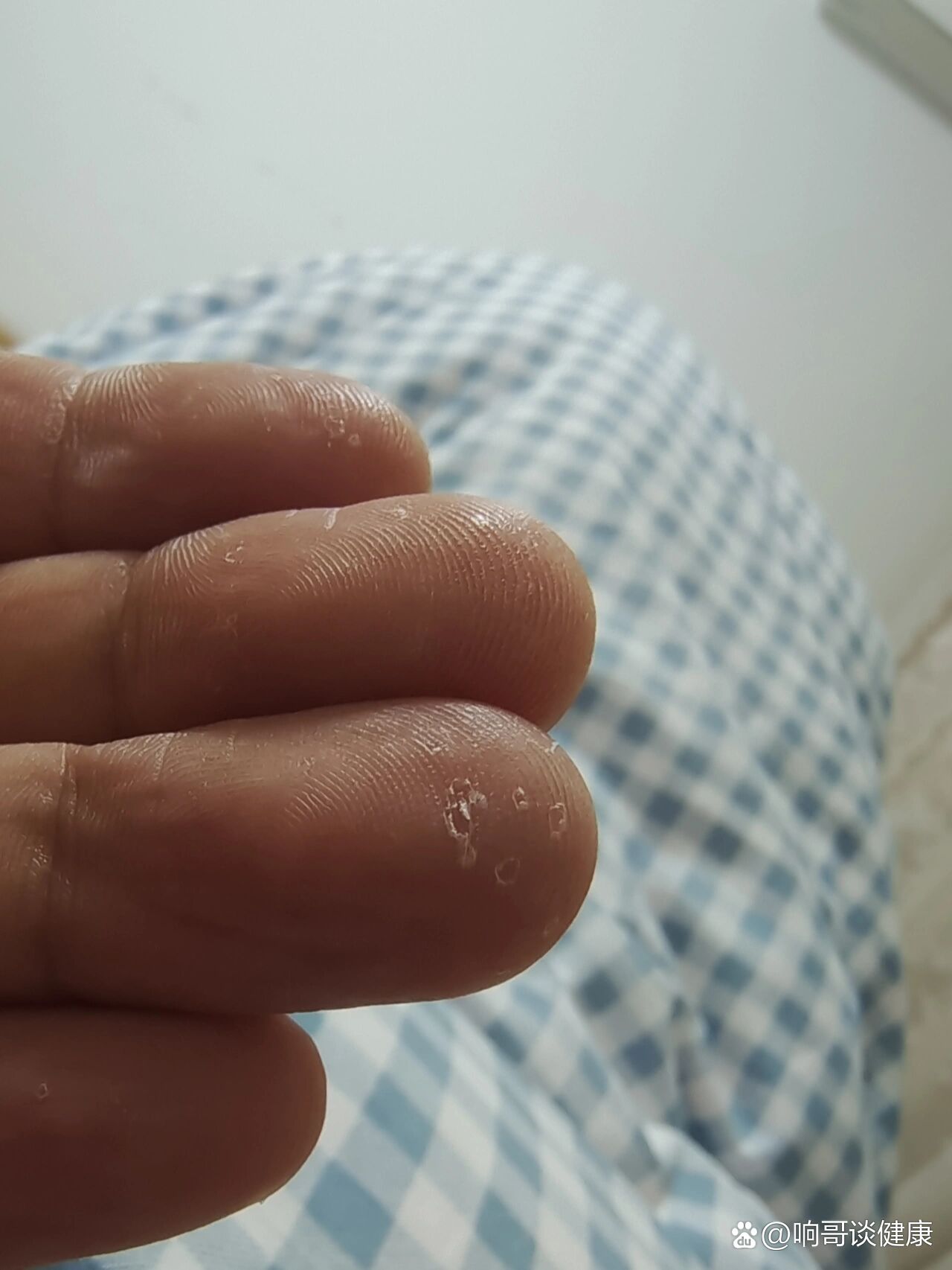 手指脱皮严重见图片