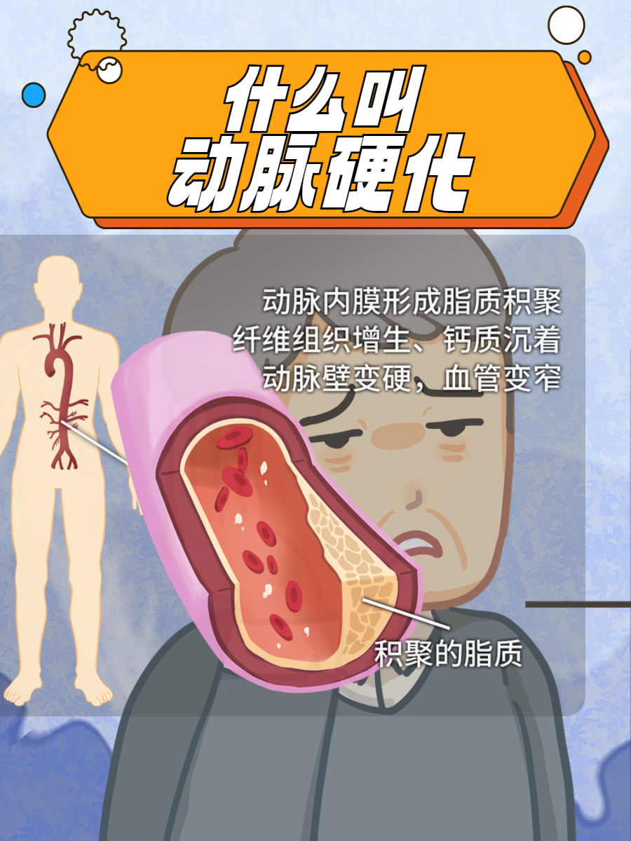 动脉血管硬化的症状