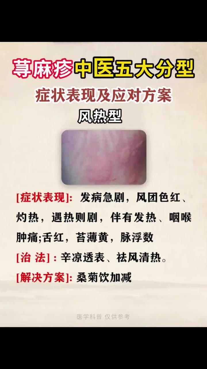 荨麻疹怎么治?