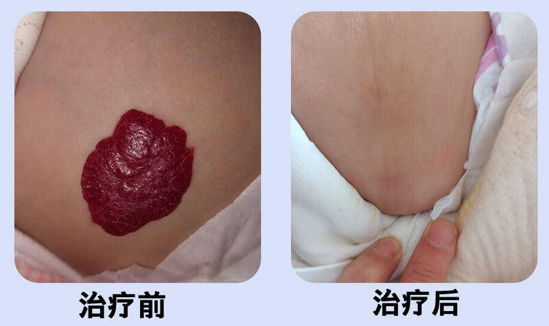 血管瘤严重吗?