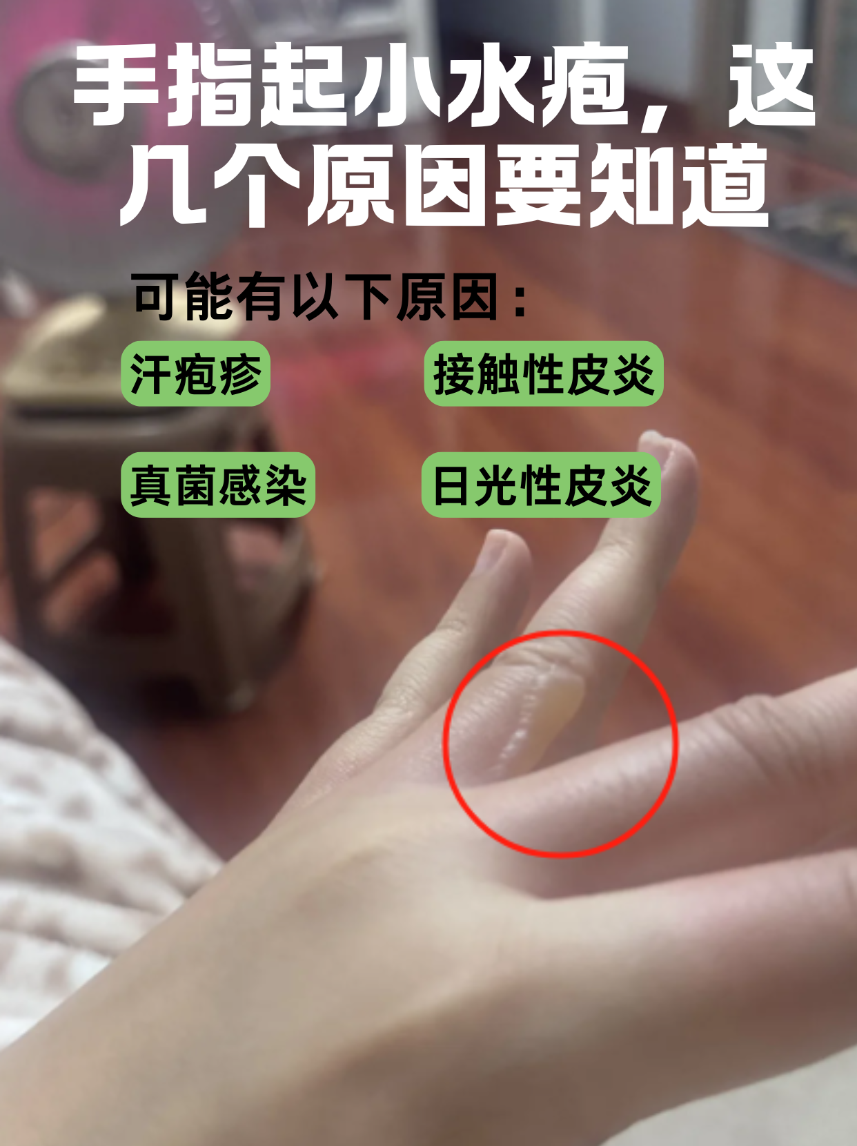 手上起小水泡是怎么回事