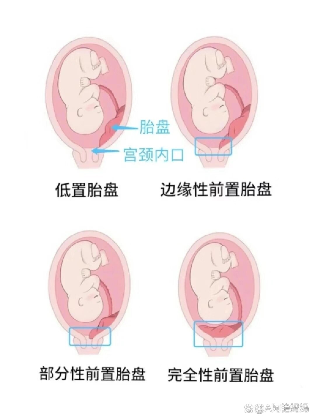 孕中期胎盘低怎么办