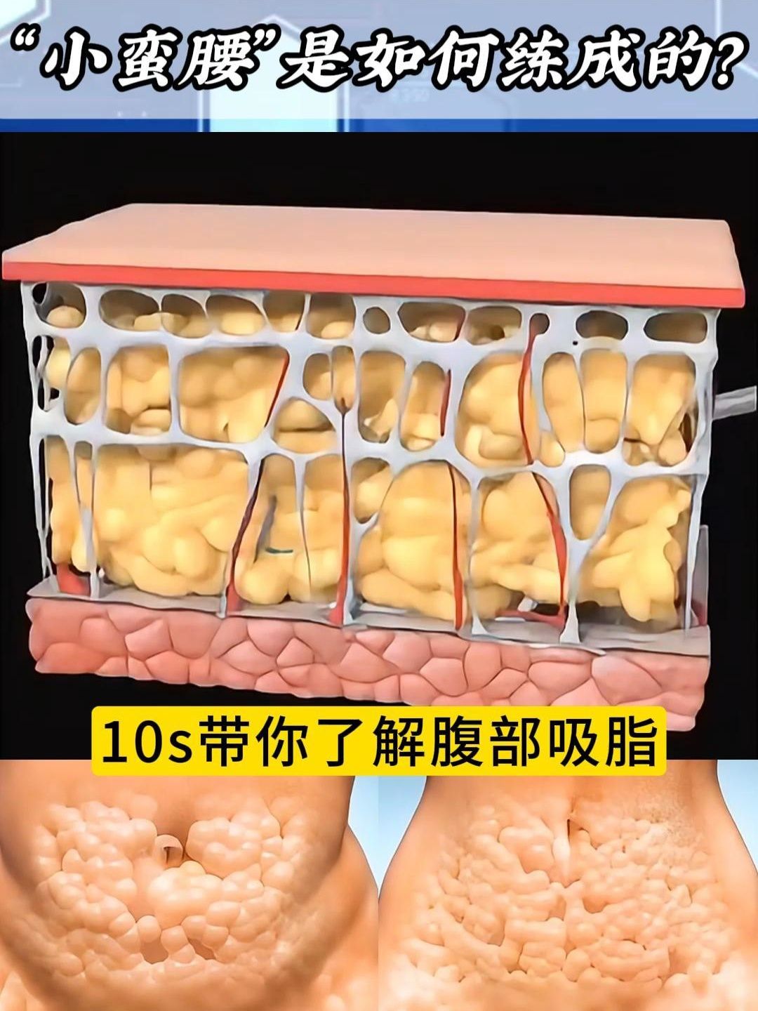 腹部吸脂减肥术