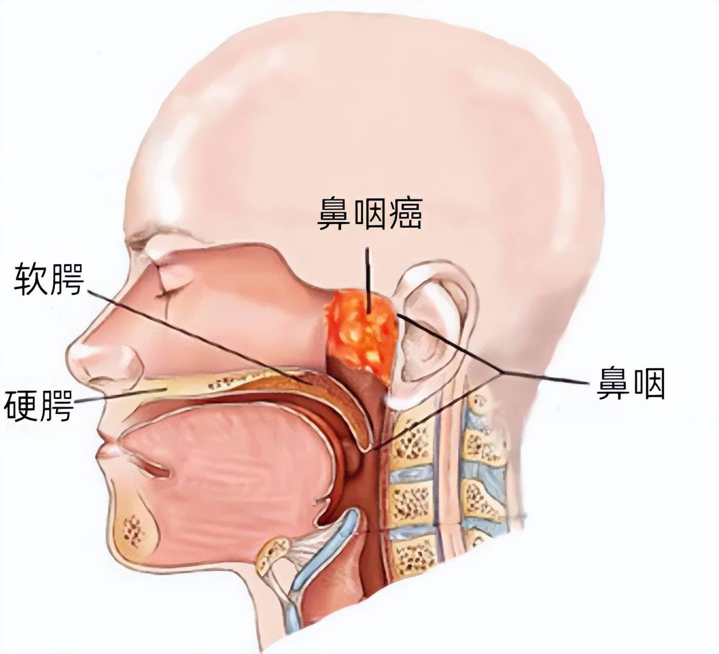 鼻咽癌有什么症状表现