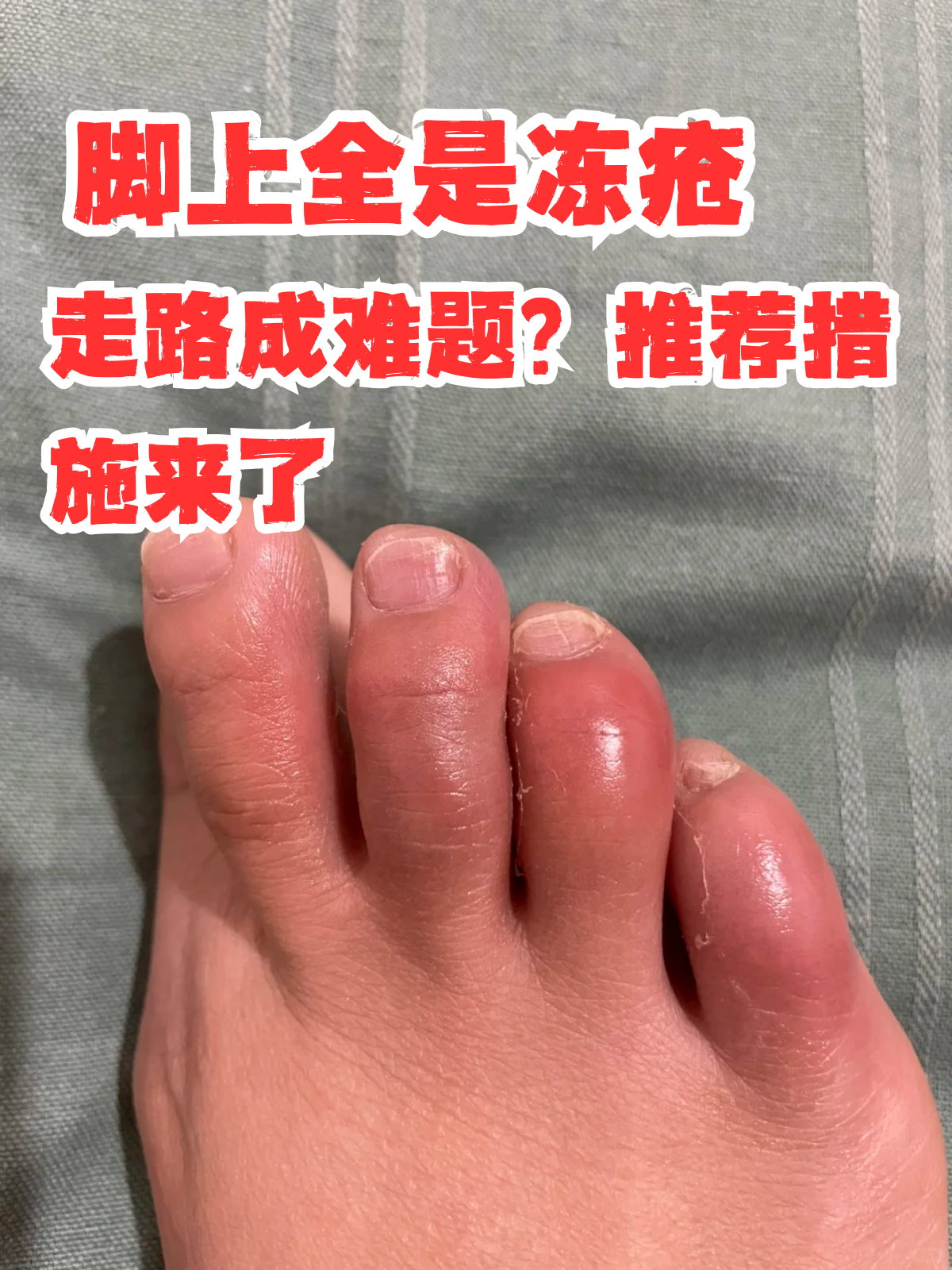 治疗冻疮的最佳方法有什么
