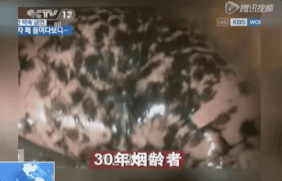 抽烟的肺是