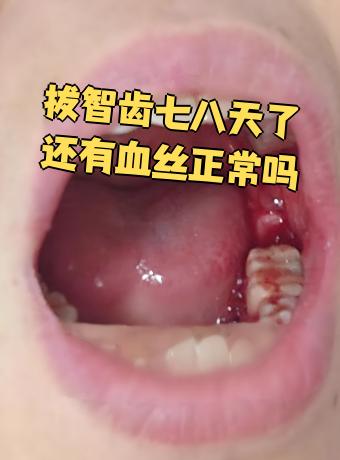 来月经最后几天能拔智齿吗?
