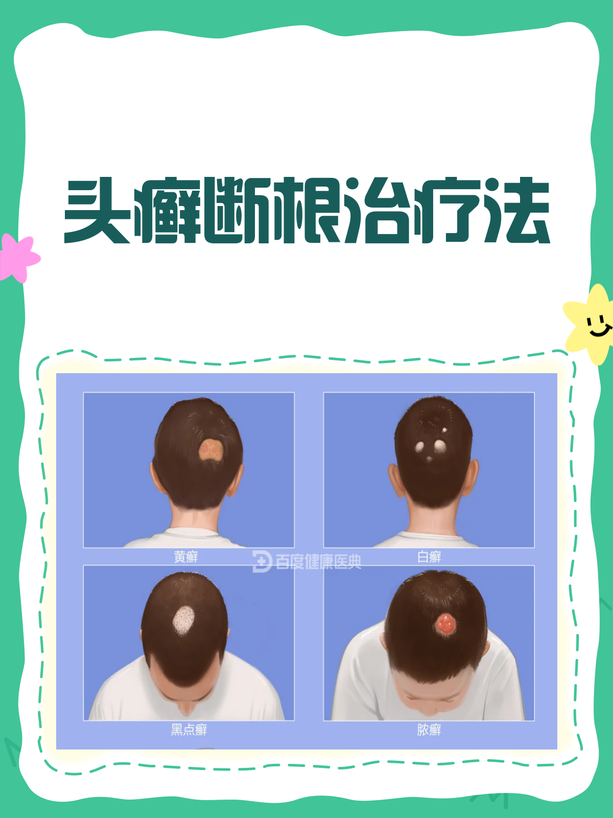 头癣怎么治才能治愈