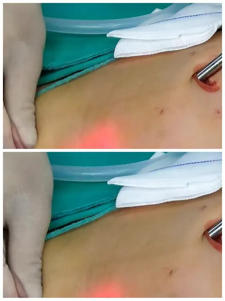 精索鞘膜积液手术