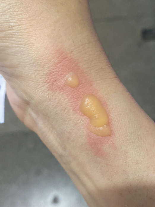 烫伤后水泡破了怎么办