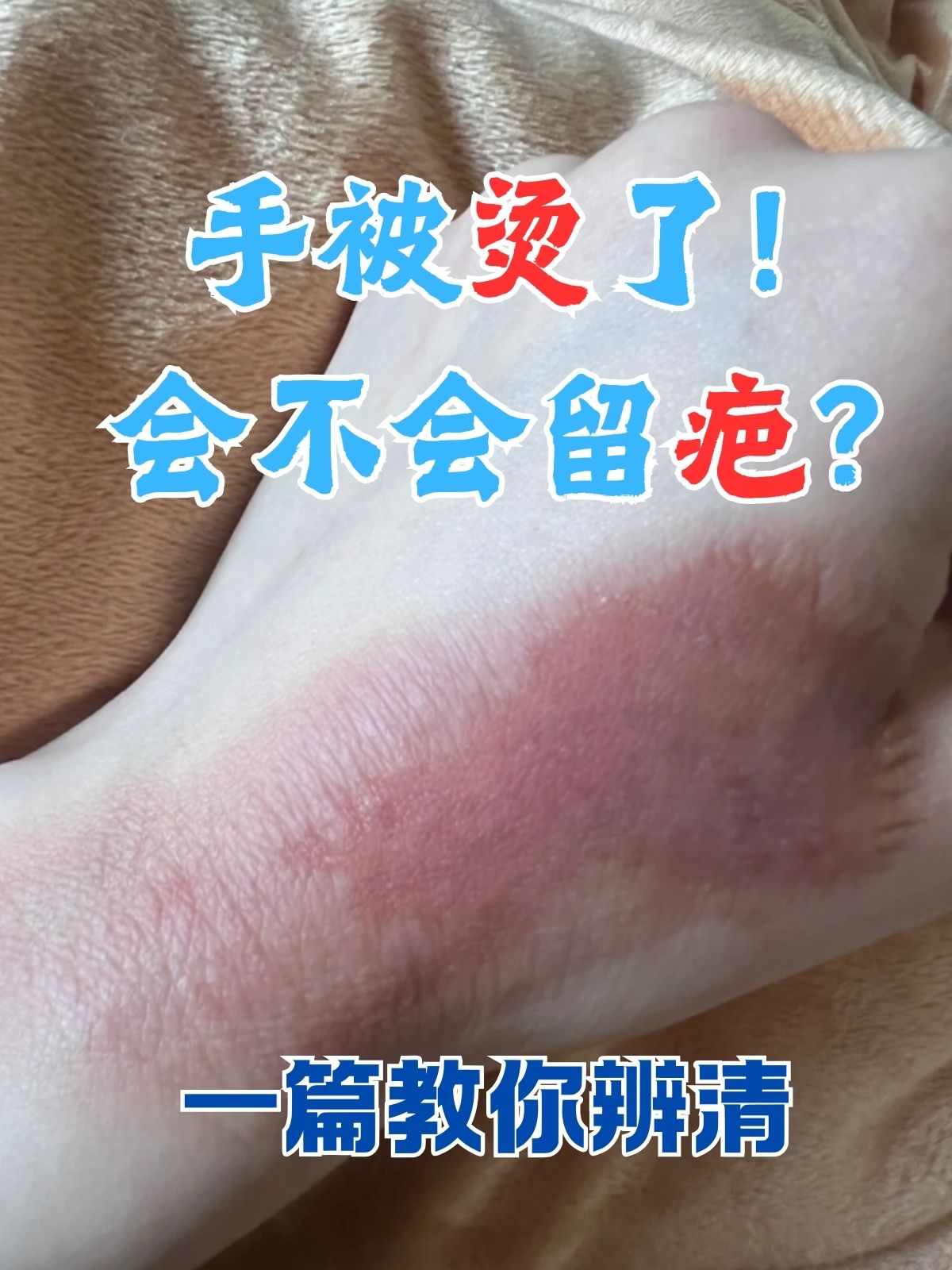 手指被烫伤了要怎么办?