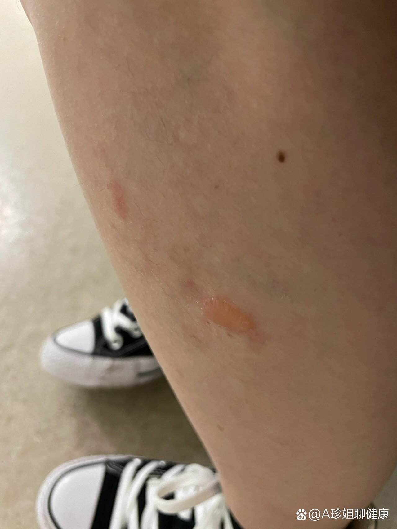 艾灸起泡意味着什么