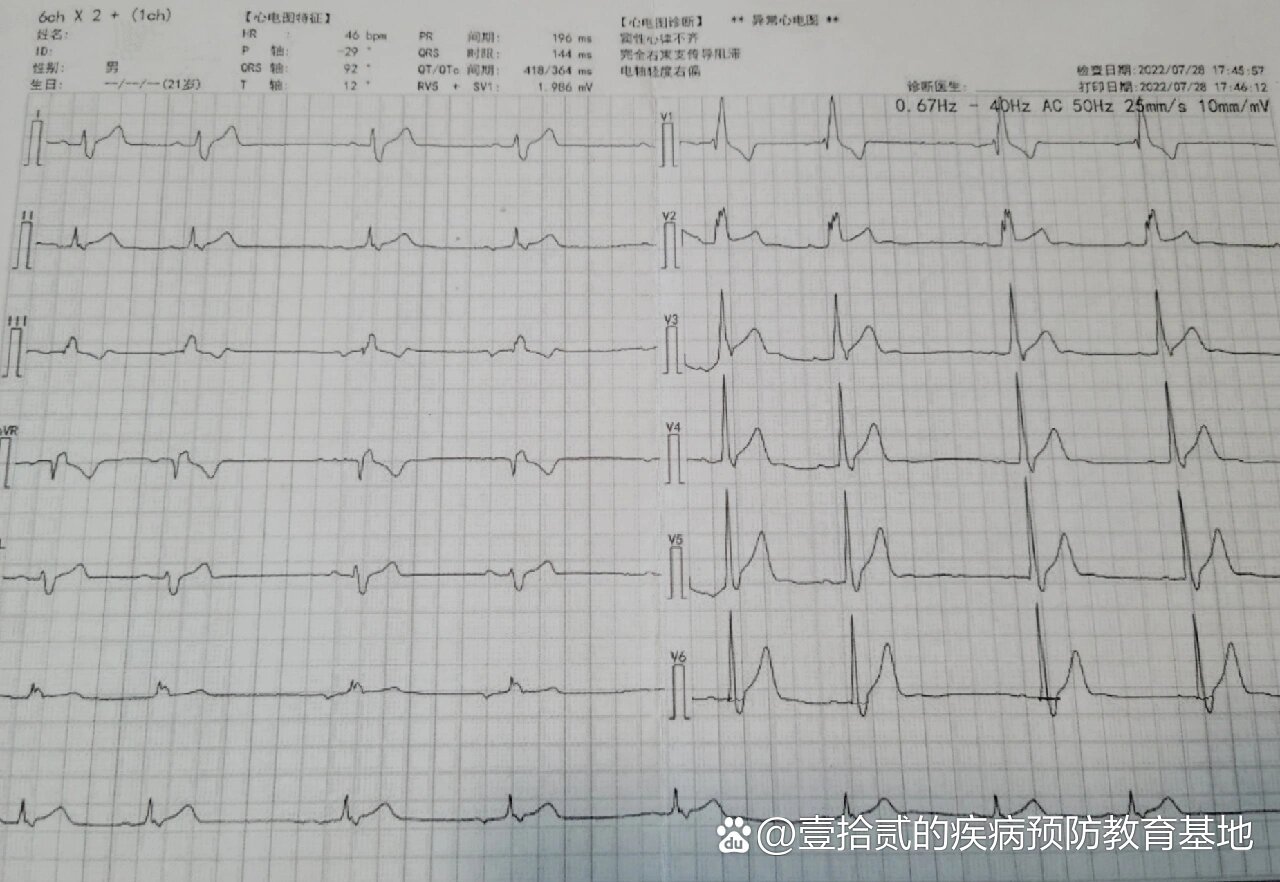 完全右传导阻滞能治好吗?.