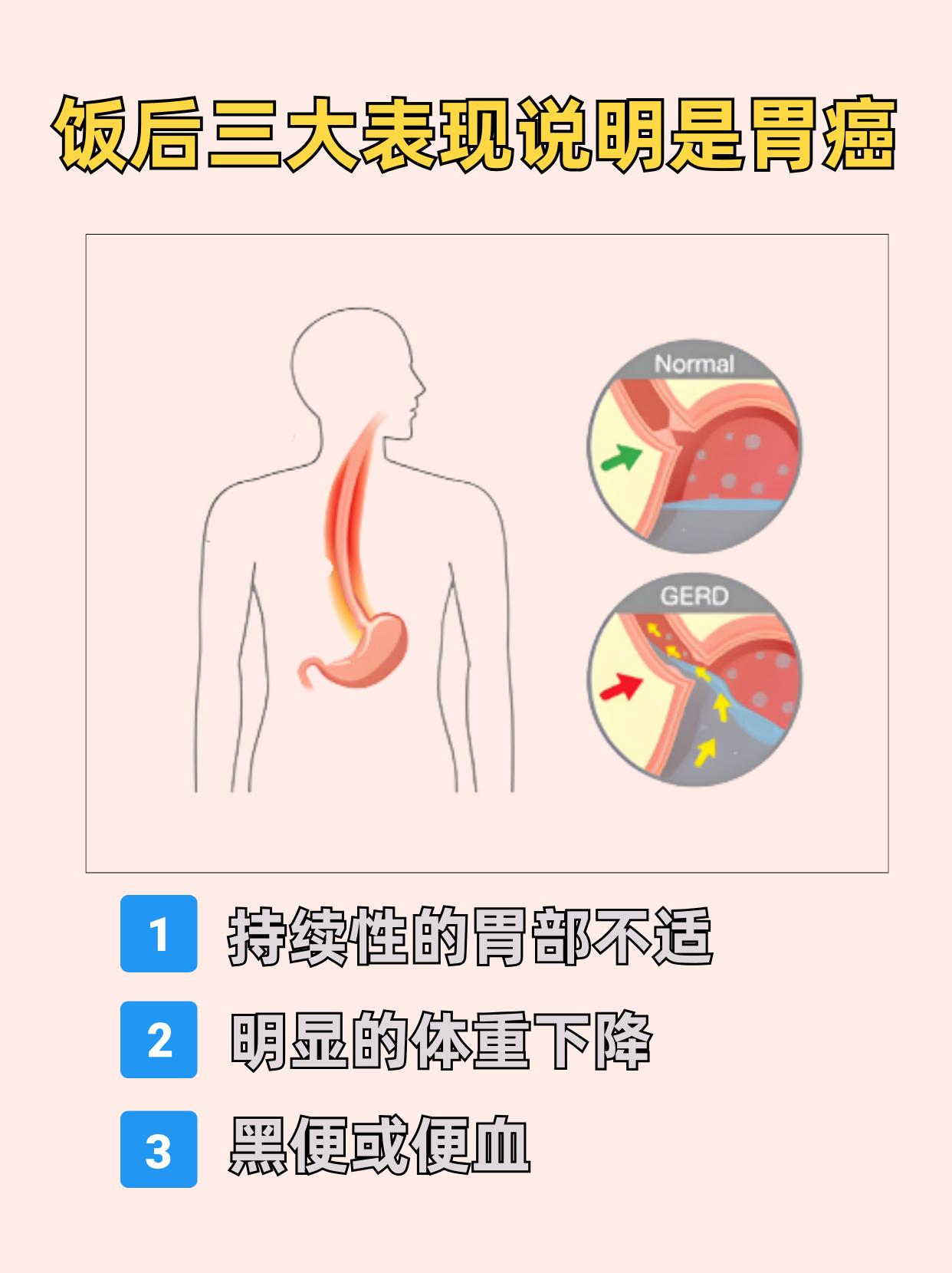胃癌是怎么个意思?