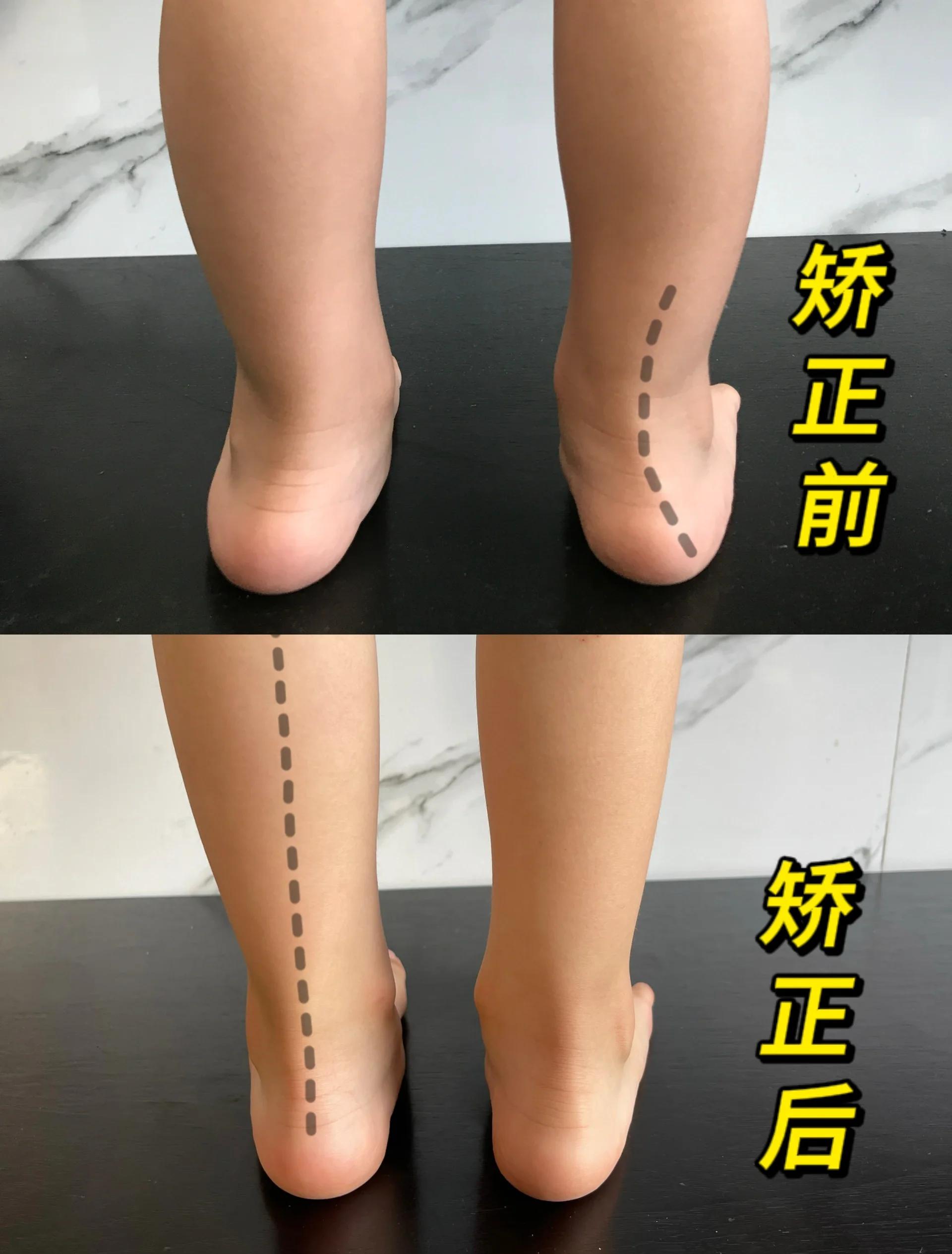扁平足的矫正方法