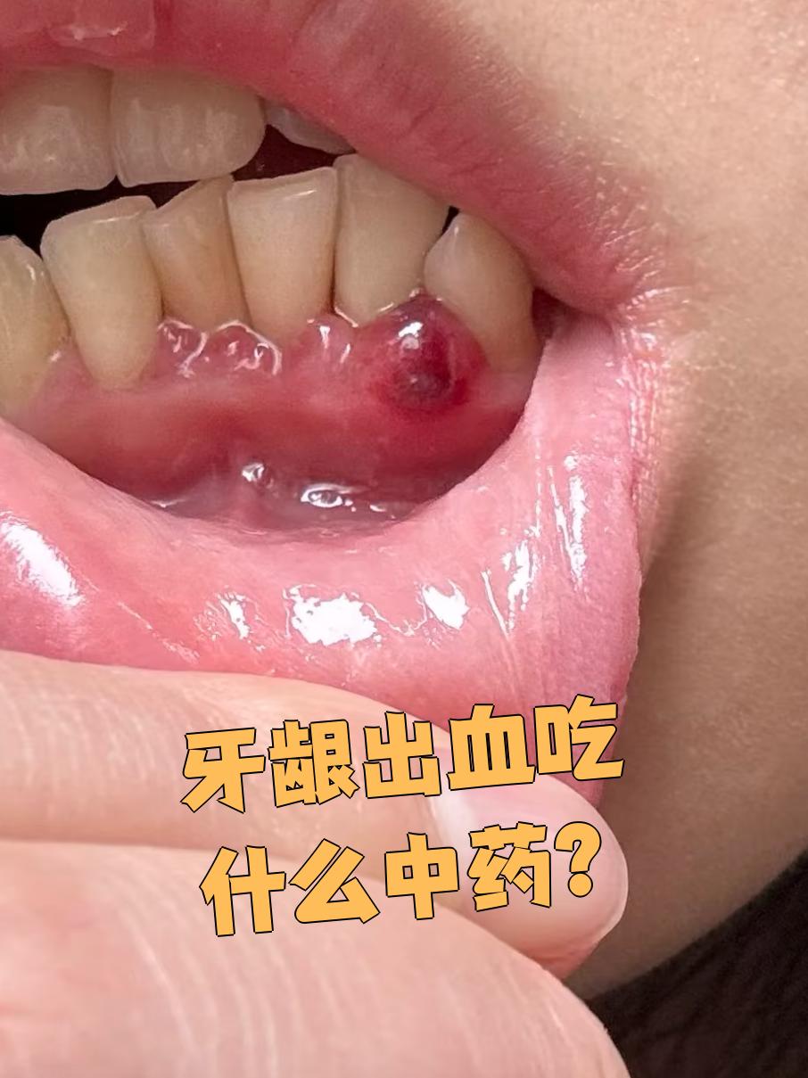 牙龈经常出血是怎么回事
