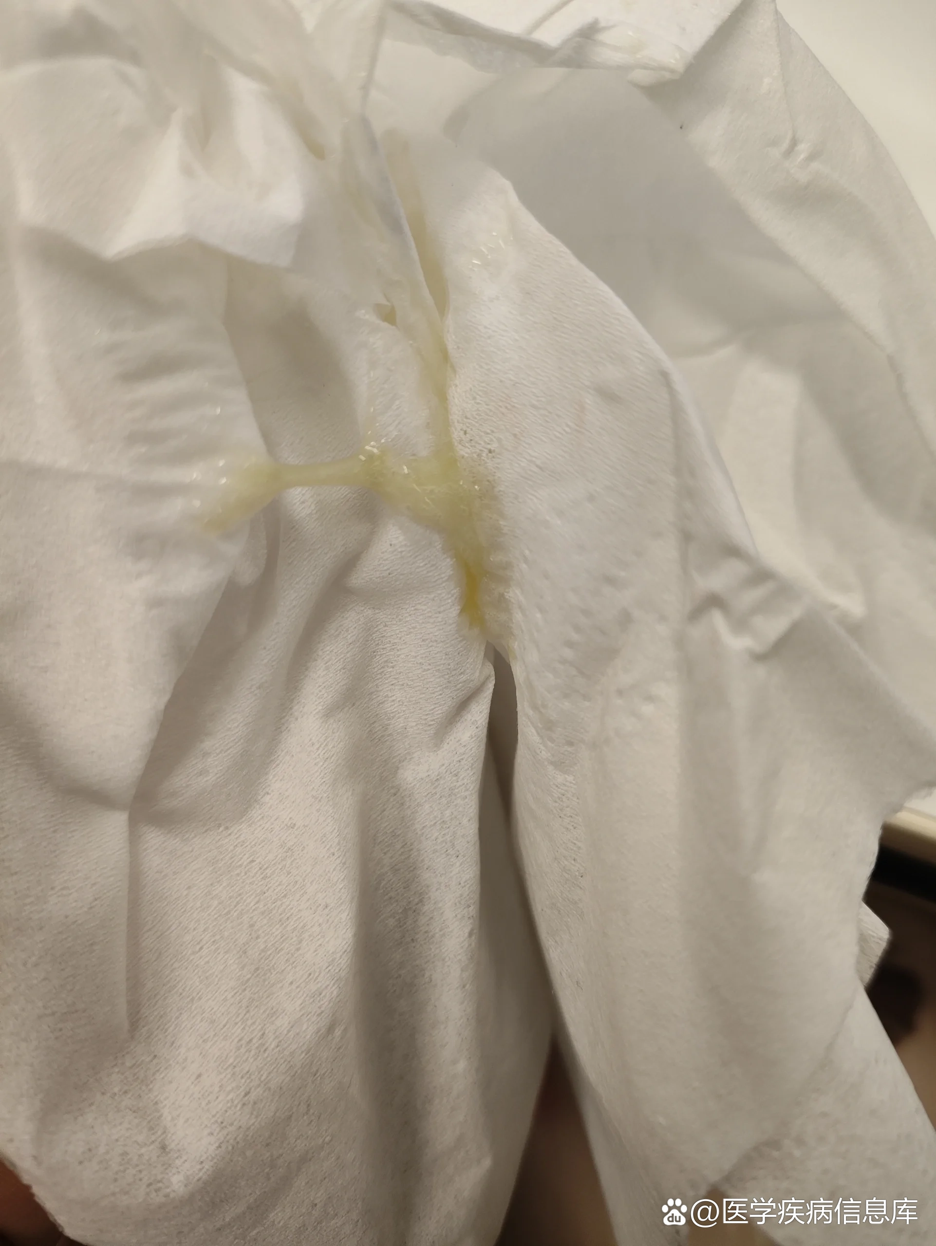 白带黄有点像鼻涕但不多不痛不痒