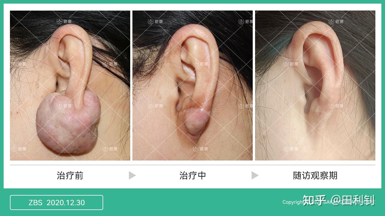 耳洞里面有硬块能挤吗