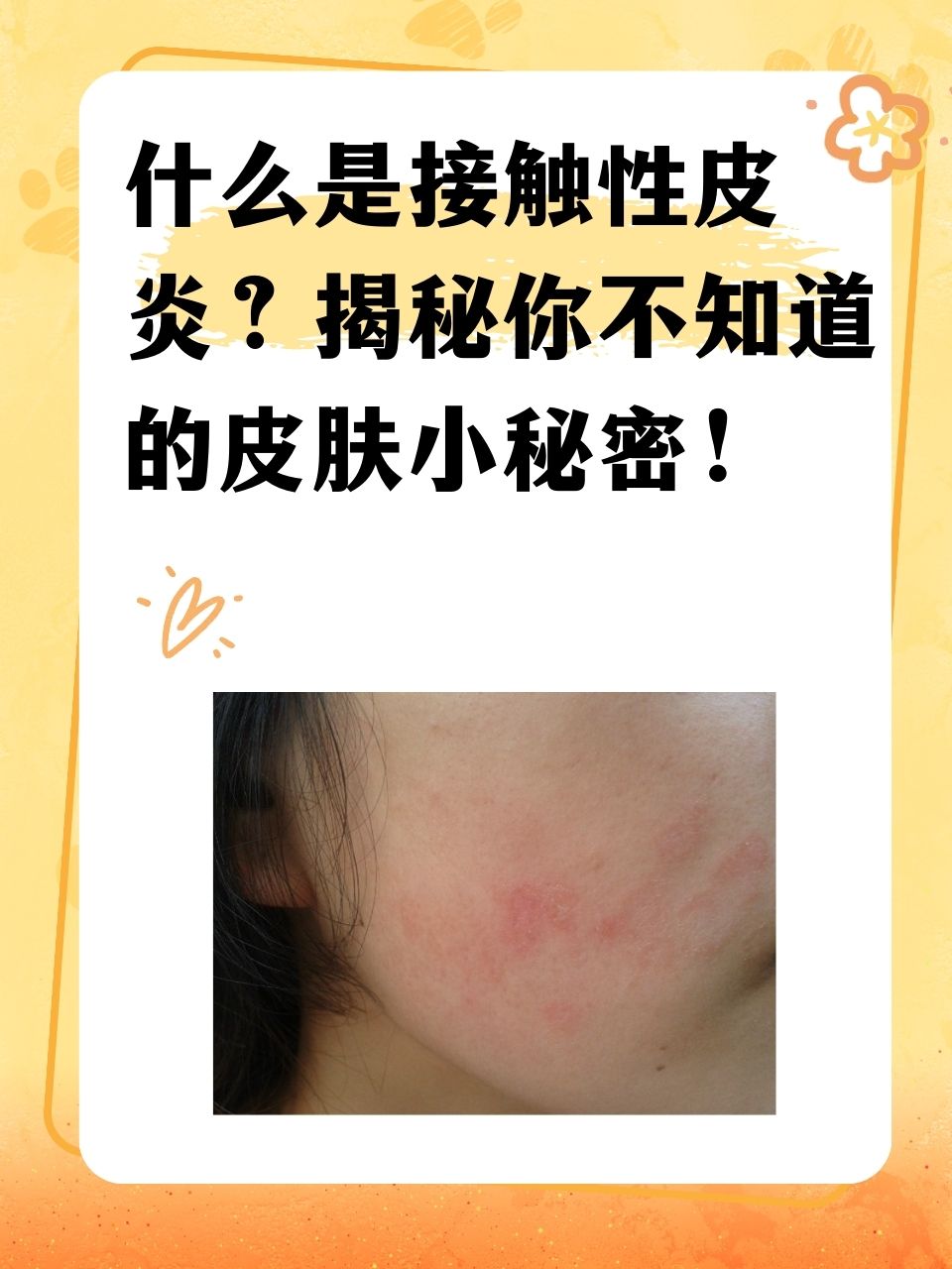 过敏性皮炎如何治疗