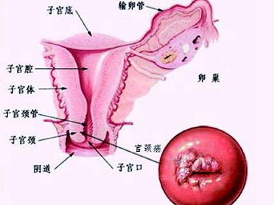 重度宫颈糜烂什么症状