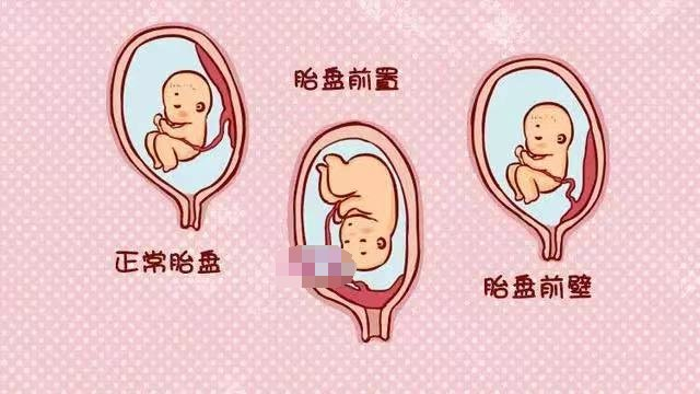 胎盘在子宫后壁是什么意思