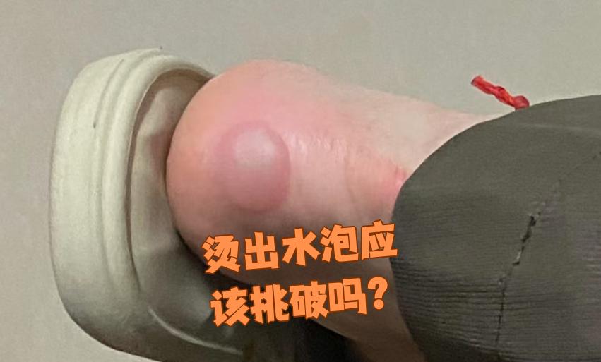 开水烫伤起水泡要不要弄破