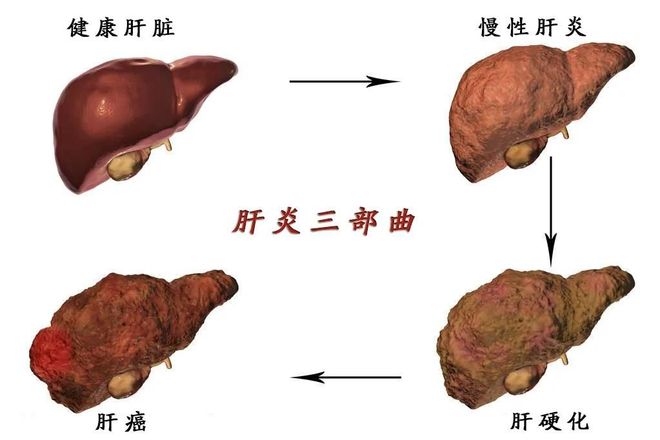 得了乙肝的人会怎么样