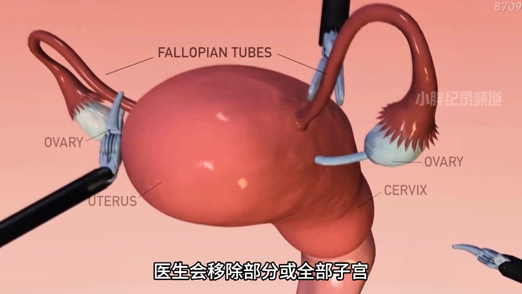 子宫切除的后遗症有哪些